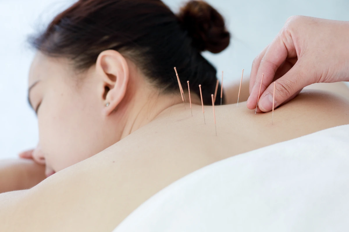 Woman lying down recieving acupuncture needles in her upper back during an acupuncture session in Burnaby.