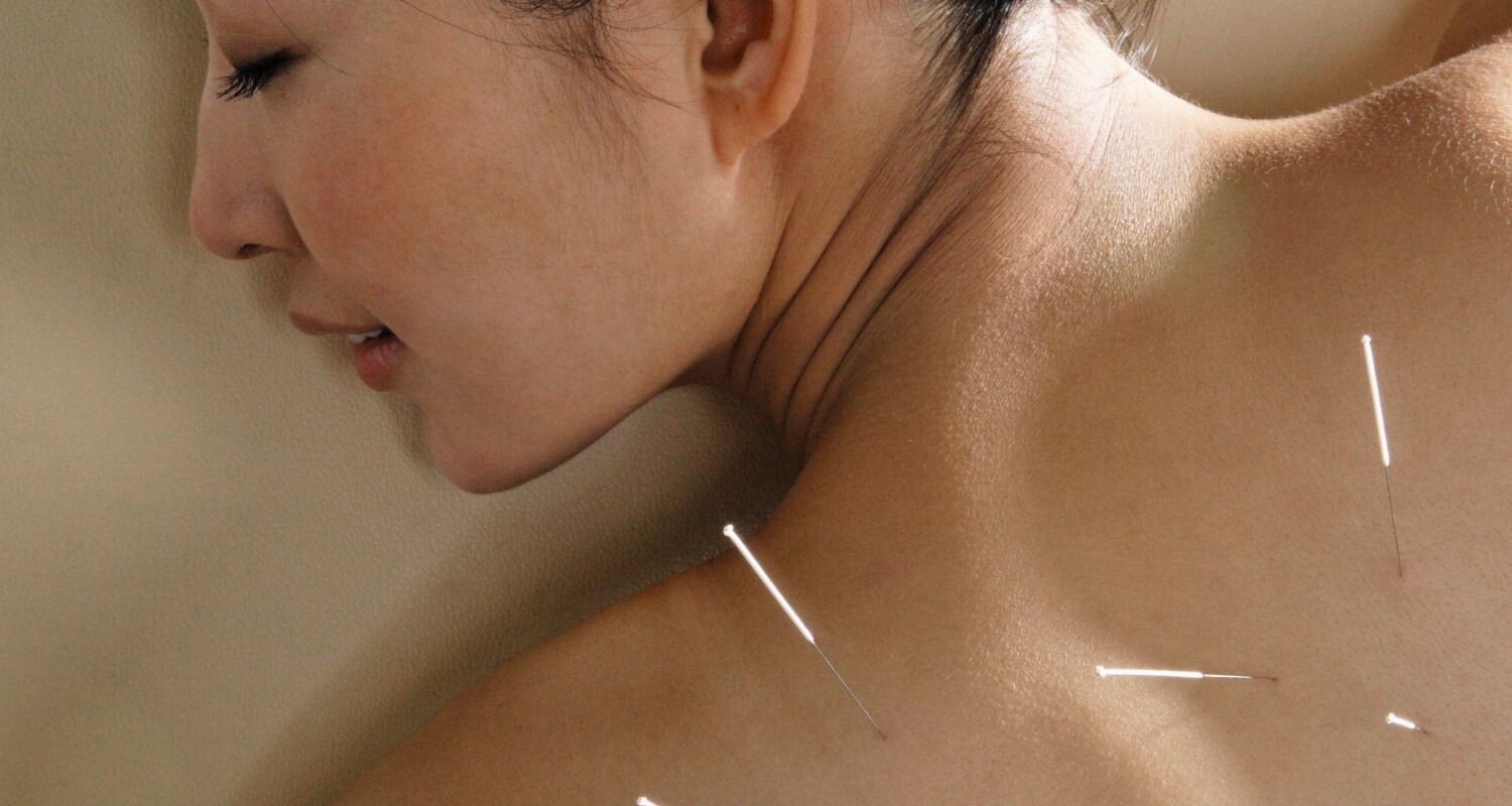 Acupuncture