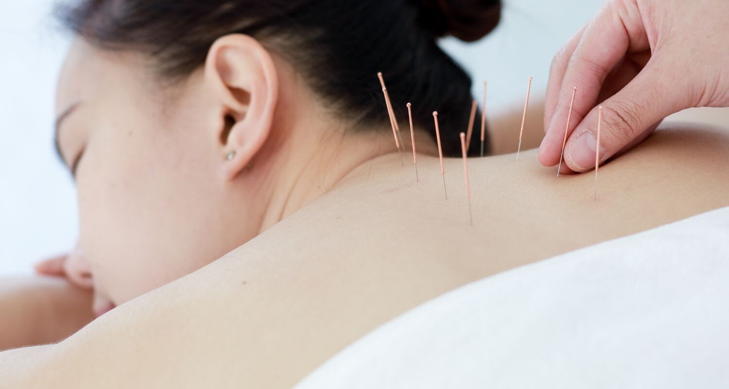 Acupuncture for neck pain