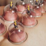 Cupping Therapy