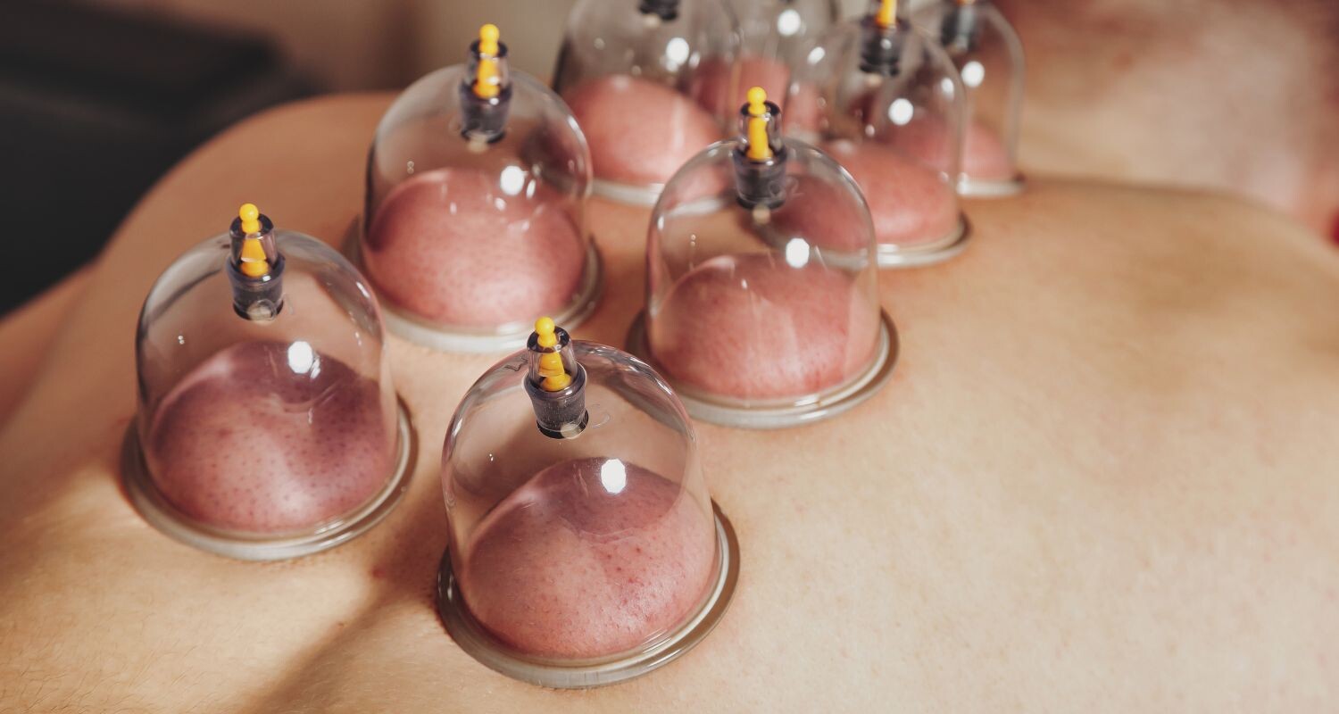 Cupping Therapy
